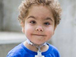 Zije tri deti, které byly zachráneny pomocí 3D vytistených rustove flexibilních implantátu