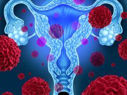 Lupus erhöht das Risiko von Gebärmutterhalskrebs für Frauen