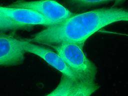 Melanom: Mutace, které mení imunitní systém, aby podporil rust nádoru