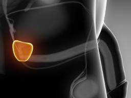 Cáncer de próstata metastásico: lo que necesita saber