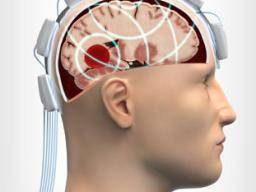 "Mikrovlnná helma" muze zkrátit dobu potrebnou k vyhodnocení zranení hlavy