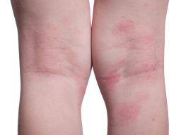 El estudio molecular de las proteínas de la piel revela la predisposición al eczema