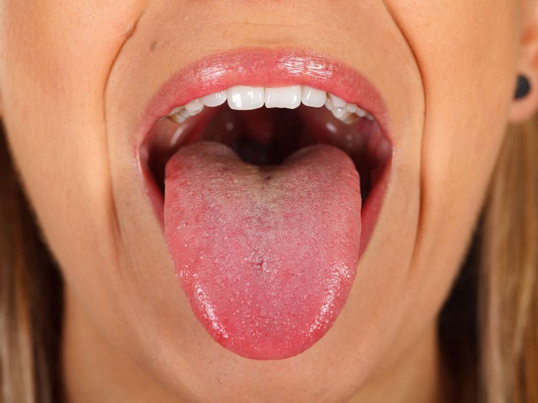 Bacterias de la boca vinculadas al cáncer de esófago