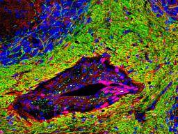 MS spoust muze být smrt bunek produkujících myelin