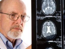 Nový prístup k lécbe Alzheimerovy choroby nalezený v nové tríde sloucenin