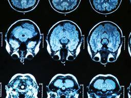 Neuer Mechanismus hinter Alzheimer-Beginn identifiziert