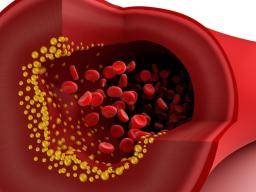Neue Studie zeigt, wie Cholesterin Krebs fördert