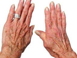 Nová cílená lécba pro artritidu vypadá slibne
