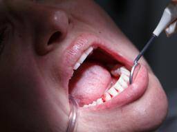 Není to jen zubní onemocnení: onemocnení parodontu spojená s rakovinou prsu