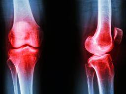 Nová lécba artritidy je mozná s novým objevem