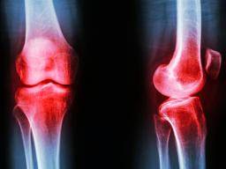 Ein Drittel aller Knieprothesen in den USA sind "unangemessen"
