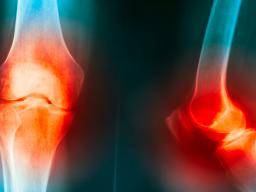 Arthrose: Kniegelenksdegeneration verlangsamt mit Gewichtsverlust, Studie bestätigt