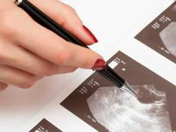 Eierstockkrebs kann früh erkannt werden, indem Zellen von der Gebärmutter oder vom Gebärmutterhals geprüft werden