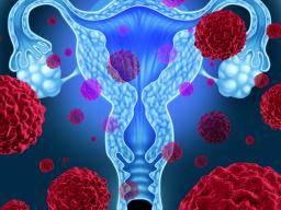 Le cancer de l'ovaire n'est pas aussi mortel qu'on ne le pensait, selon une étude