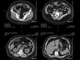 Kmenové nádory pankreatu - nová milimodální lécba