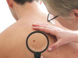 Lidé s mensím mnozstvím krtku mohou celit riziku agresivnejsího melanomu