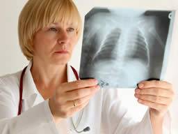 Mögliche Behandlung für zystische Fibrose-Lungenerkrankung