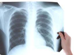 Viel versprechendes neues TB-Medikament wird genehmigt, aber die Fragezeichen bleiben bestehen