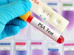 Prostatos vezys: PSA patikra mazina mirties rizika, sako apzvalga