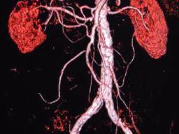 Závaznost psoriázy predpovídá riziko abnormálních aneurzmatu aorty