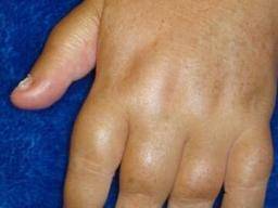 Infekce psoriatické artritidy: Co potrebujete vedet