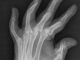 Radiologie der Psoriasis-Arthritis: Bildgebende Diagnostik