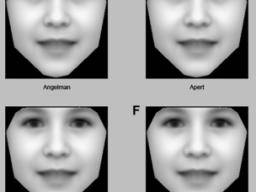 Vzácné genetické poruchy diagnostikované pocítacovou analýzou fotografií