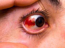 Rote Augen: Liste der häufigsten Ursachen