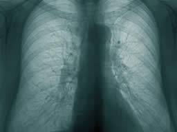 Resistente TB verbreitet sich in Europa mit beängstigender Geschwindigkeit, WHO