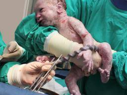 Anstieg von Neugeborenen auf der Intensivstation aufgenommen werden