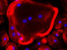 Une découverte scientifique pourrait empêcher le cancer du sein de se propager aux os