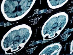 Wissenschaftler entdecken neues Gen für verheerende Form der Epilepsie
