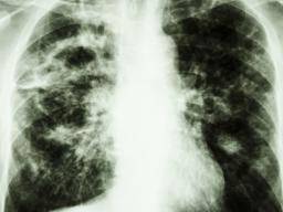 Los científicos encuentran proteínas que pueden retrasar la enfermedad pulmonar mortal