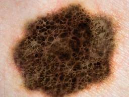 Vedci identifikují jiný casto mutovaný gen v melanomu