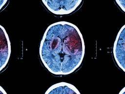 Los científicos sondean el vínculo entre el accidente cerebrovascular y el cáncer