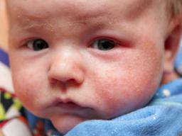 Sezóna narození spojená s rizikem alergie