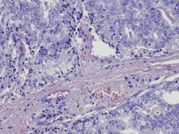 Les cellules cancéreuses «Shapeshifting» favorisent la métastase