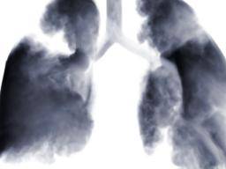Kleinzelliger Lungenkrebs: Thorax-Strahlentherapie "verlängert das Überleben, reduziert das Wiederauftreten"