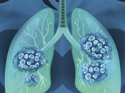 Kleinzelliger Lungenkrebs: Was Sie wissen müssen
