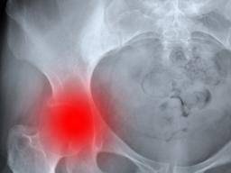 La inyección de células madre revierte la osteoporosis en ratones