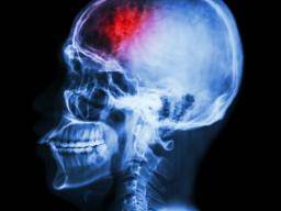 El daño cerebral por accidente cerebrovascular podría revelar la clave para tratar la adicción