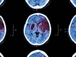Accident vasculaire cérébral: les patients hispaniques ont des délais de traitement retardés, selon une étude
