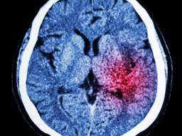 Mrtvice: Nové léky omezují poskození mozku a podporují opravu