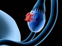 Studie zjistuje 12 genetických variant, které zvysují riziko vzniku rakoviny vajecníku