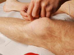 Studie findet Akupunktur ist "nicht vorteilhaft für Knieschmerzen"