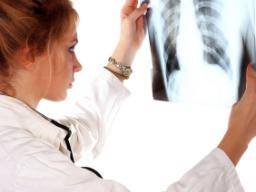 Studie identifiziert Verzögerungen bei der Behandlung von Lungenkrebs aufgrund versäumter diagnostischer Tests