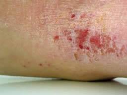 Estudio de infecciones asociadas con Eczema