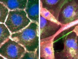 Un estudio muestra cómo las células del cáncer de pulmón se "despegan" y se propagan