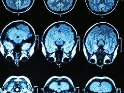 Die Studie validiert die erste "Goldstandard" -Technik zur Identifizierung von frühen Anzeichen von Alzheimer