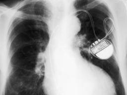 Herzschrittmacher mit "Testfahrten" können es den Patienten ermöglichen, fundiertere Entscheidungen zu treffen